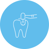 虫歯治療 ダイレクトボンディング